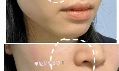 法令纹浅层玻尿酸