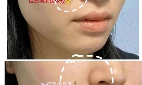 国产玻尿酸填法令纹