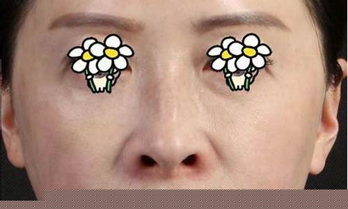 填充法令纹需要几支玻尿酸